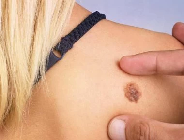 Μελάνωμα: Πώς μπορεί να συμβεί σε όσους δεν κάθονται στον ήλιο